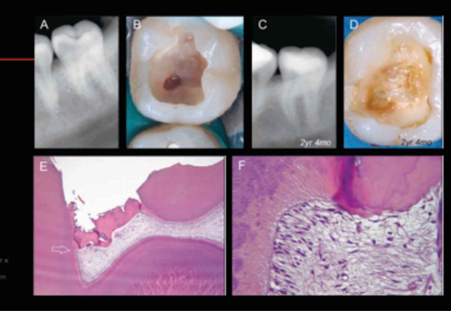 <ul><li><p>Formed in response to <strong>pulp exposure</strong></p></li><li><p>Often forms a <strong>dentin bridge</strong></p></li><li><p>can stimulate pulp to create dentin bridge with products</p></li></ul><p></p>