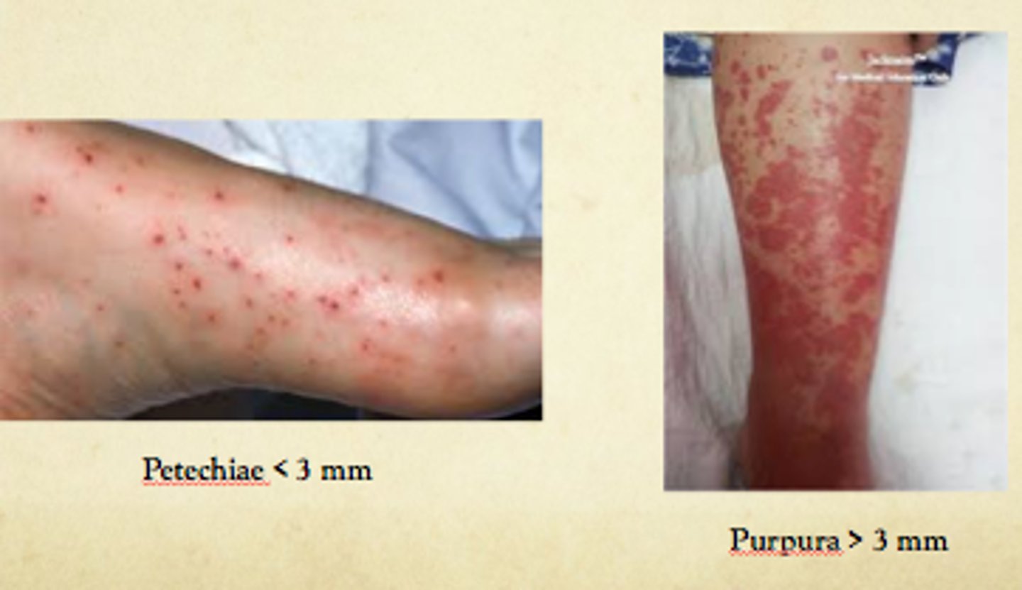 <p>A petechia, plural petechiae, is a small red or purple spot on the skin, caused by a minor bleed from broken capillary blood vessels. Petechia refers to one of the three descriptive types of bleeding into the skin differentiated by size, the other two being purpura and ecchymosis. Petechiae are by definition less than 3 mm.</p>