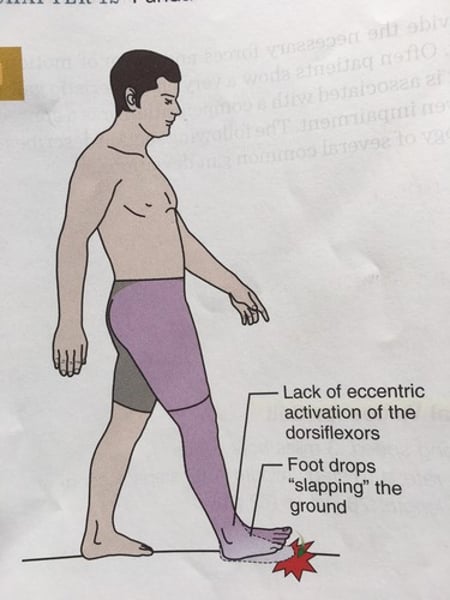 <p>weak dorsiflexors, dorsiflexor paralysis</p>