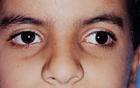 <p>This is a picture of the following condition:</p>