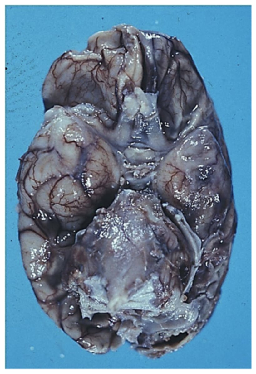 <p>What are the 2 main features of the CSF in tuberculosis meningitis?</p>