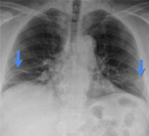 <p>confirms atelectasis, differentiates from air-space opacification</p>