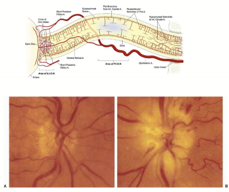 <ul><li><p>Sudden <strong>painful </strong>unilateral irreversible vision loss: diffuse vision loss or inferior altitudinal defect; Relative afferent pupillary defect (RAPD)</p></li><li><p>Pale, edematous optic nerve; often with flame-shaped hemorrhages</p></li><li><p><strong>Can become bilateral vision loss within 24 hours</strong></p></li></ul><p></p>
