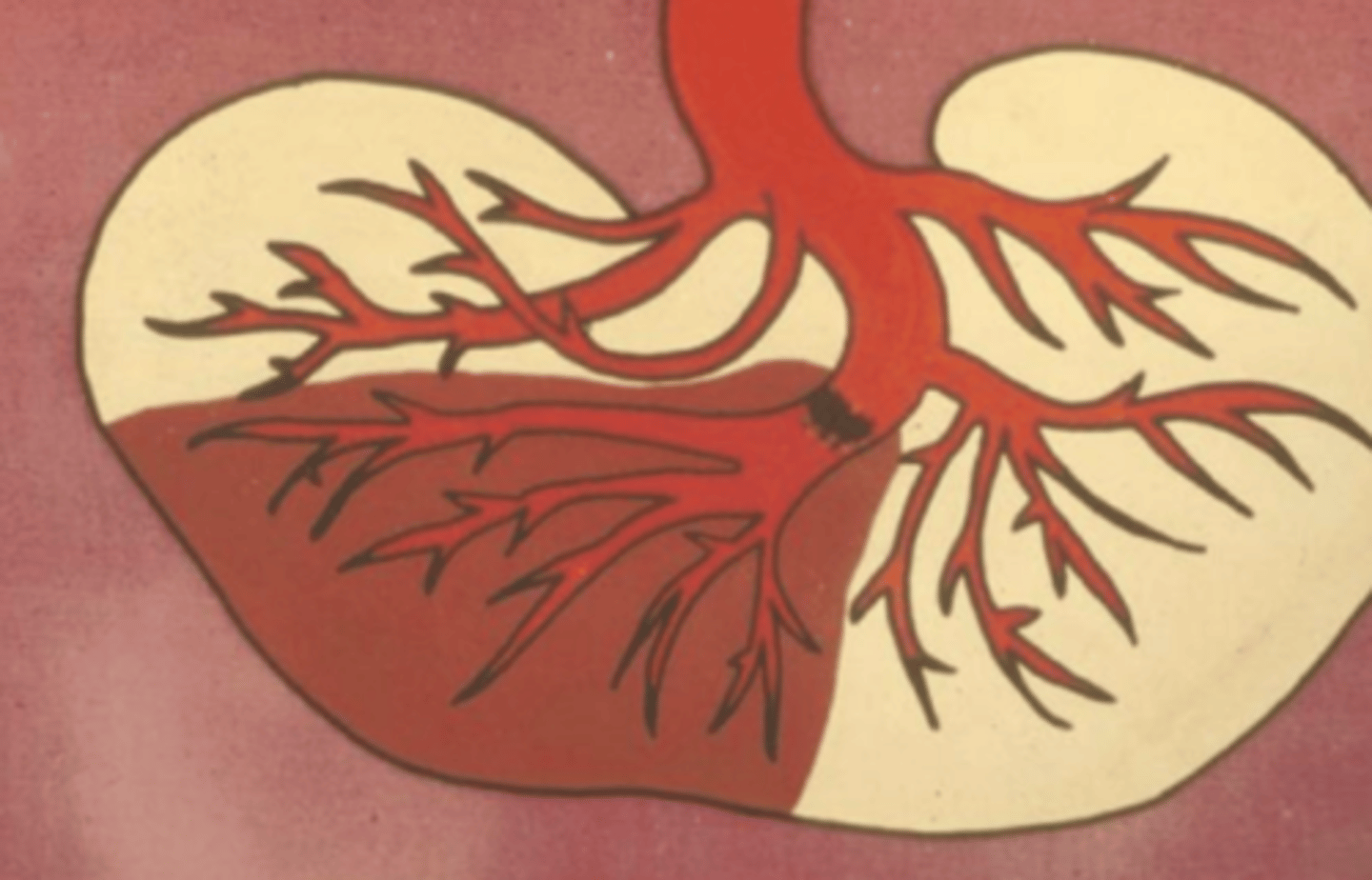 <p>- Infarcts usually appear dark red right after they occur. Most infarcted areas are wedge-shaped, with the apex pointed towards the occluded vessel. Grossly, the margins become fairly well-defined within 24 hours; white infarcts typically go on to become very well-demarcated and paler over the next several days.</p>