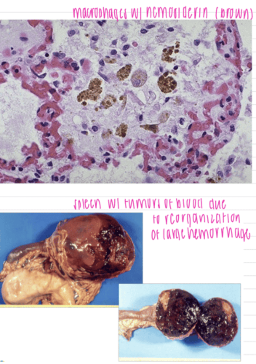 <p>reabsorption- if it is a small amount of blood, macrophages with phagocytize it and are loaded with hemosiderin,</p><p>reorganization- if it is a large amount of blood, the hematoma is surrounded by a fibrous CT capsule and macrophages with enter to phagocytize it</p>