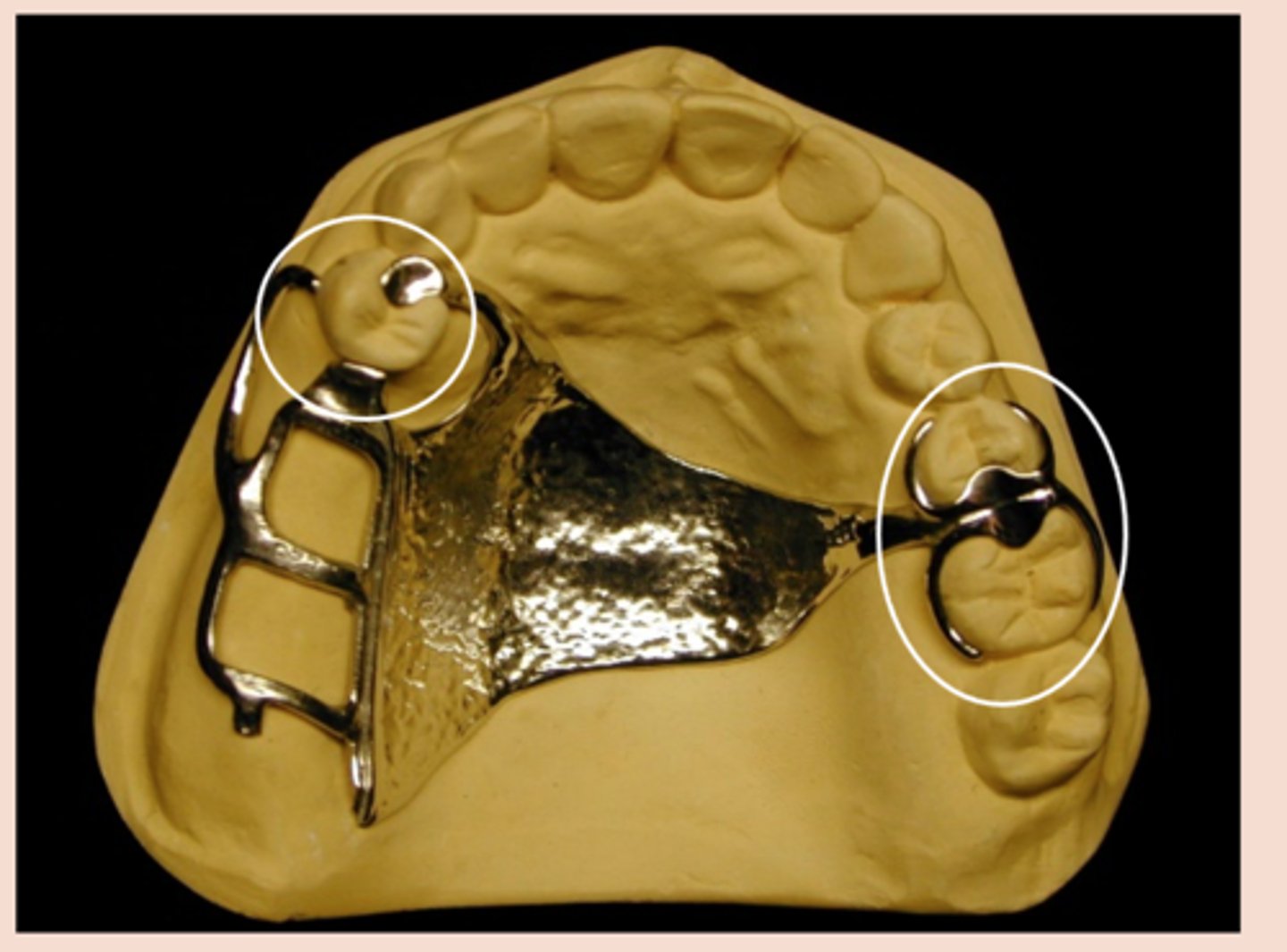<p>An extra coronal direct retainer that engages an abutment tooth for retention, stability and support of the partial denture</p><p>§Akers</p><p>§Embrasure</p><p>§RPI</p><p>§RPC</p><p>§Combination</p>