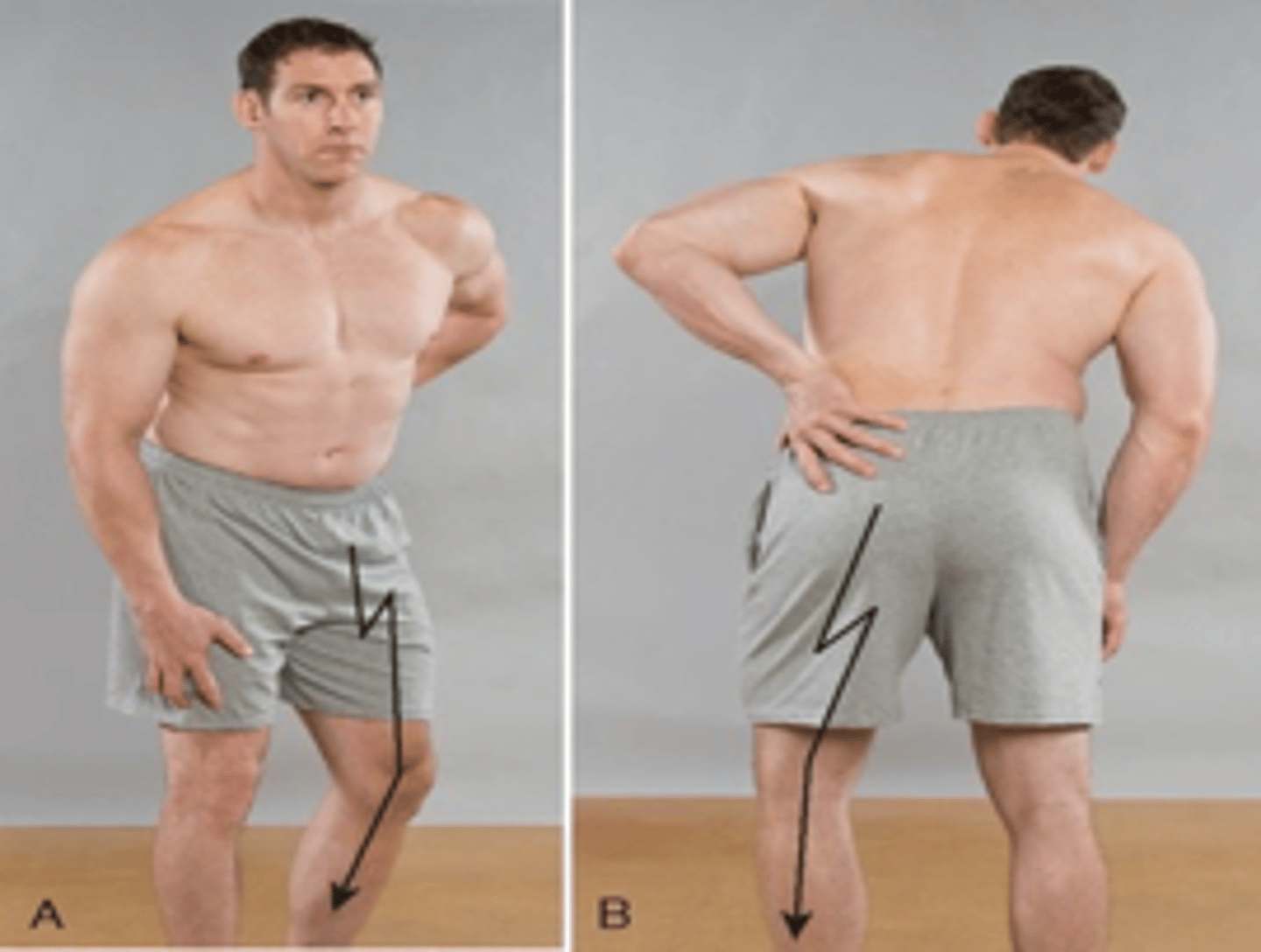 <p>When the disc protrudes lateral to the nerve root, the patient assumes an antalgic lean away from the side of the disc lesion or pain</p>