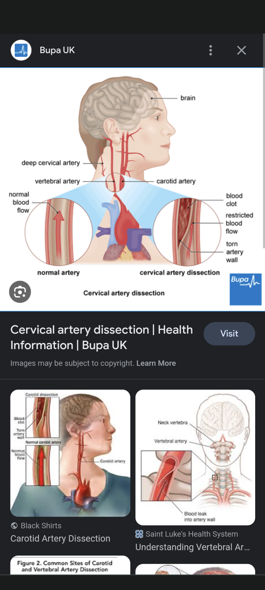 <p></p><ul><li><p>Description: Form basilar artery, supply brainstem, cerebellum.</p></li></ul>