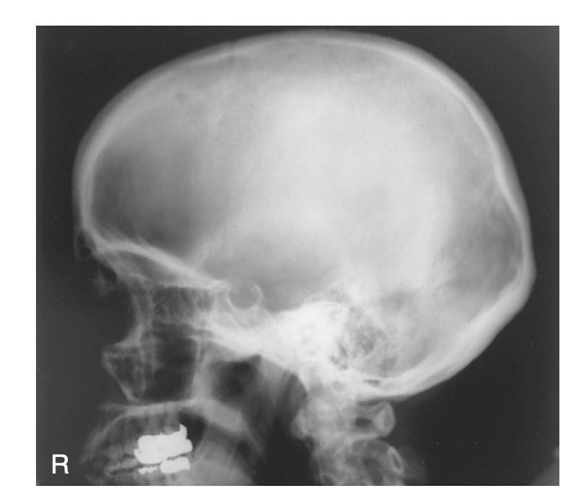 <p>How do you <u>critique</u> radiograph of <strong>RT and LT lateral </strong>method for <strong>skull</strong>?</p>