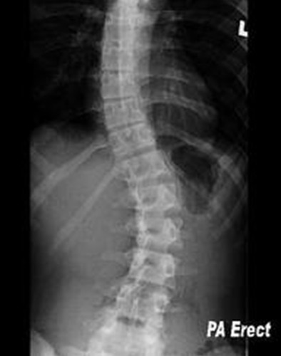 abnormal lateral curvature of the spine
