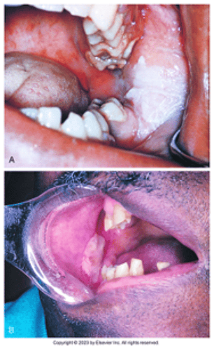 <p>Topical application is a common misuse of this product; The tissue becomes necrotic & white; Surface may slough off, leaving a painful ulcer; Usually heals in 7-21 days</p><p><br>Your patient is complaining of a toothache in the LL posterior. During the EIOE, you notice a white to gray patch on the left buccal mucosa.</p><p>•What do you suspect is the cause of this lesion?</p><p>What question would you ask the patient?</p>