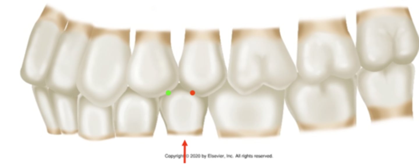 <p>ID the occlusion classification:</p>