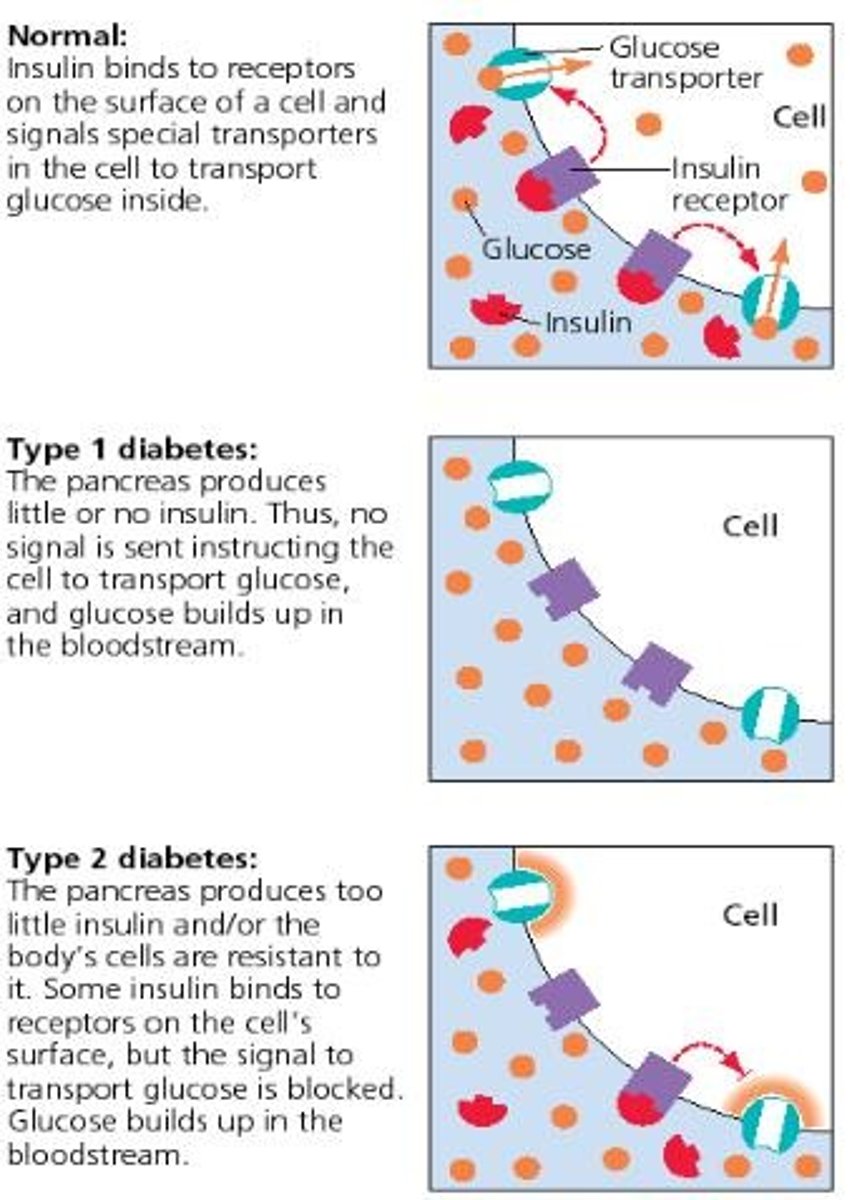 <p>• Can occur at any age</p><p>• Most often diagnosed in children, teens, or young adults.</p><p>• Body makes little or no insulin.</p><p>• Insulin injection</p><p>• Exact cause unknown</p>