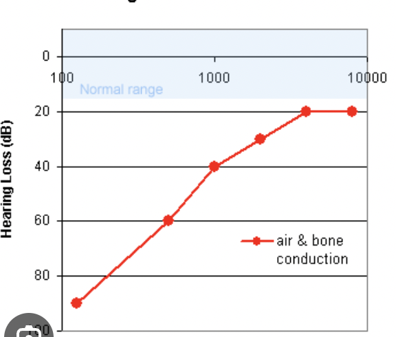<ul><li><p>Pressure equalization problems in the cochlea and semicircular canals</p></li><li><p>TINNITUS, VERTIGO</p></li><li><p>Fluctuating sensorineural hearing loss (low frequency loss — rising audiogram)</p></li><li><p>Unilateral</p></li><li><p>Poor word recognition scores</p></li></ul><p></p>
