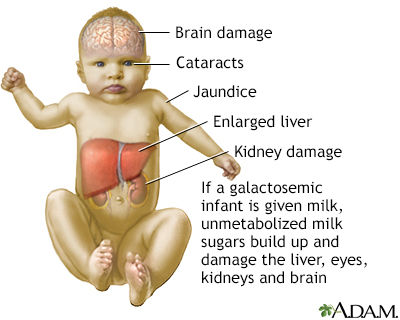 <p>Galactosemia is a disorder of ____ metabolism. </p>