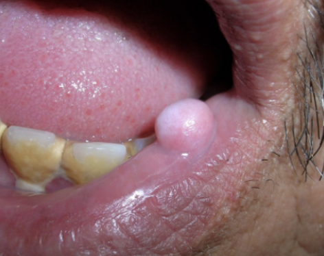 <p><span>&nbsp;benign fibroma caused by trauma, painless asymptomatic</span></p>