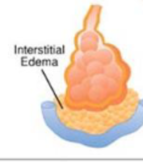<ul><li><p>froth in between alveolus and capillary</p></li><li><p>sepsis, surgery reaction, trauma</p></li></ul><p></p>