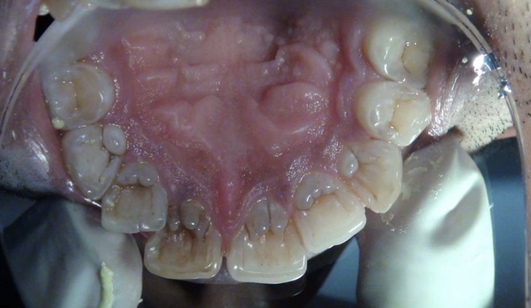 <p>Dens in dente on CI (clinical considerations)</p>