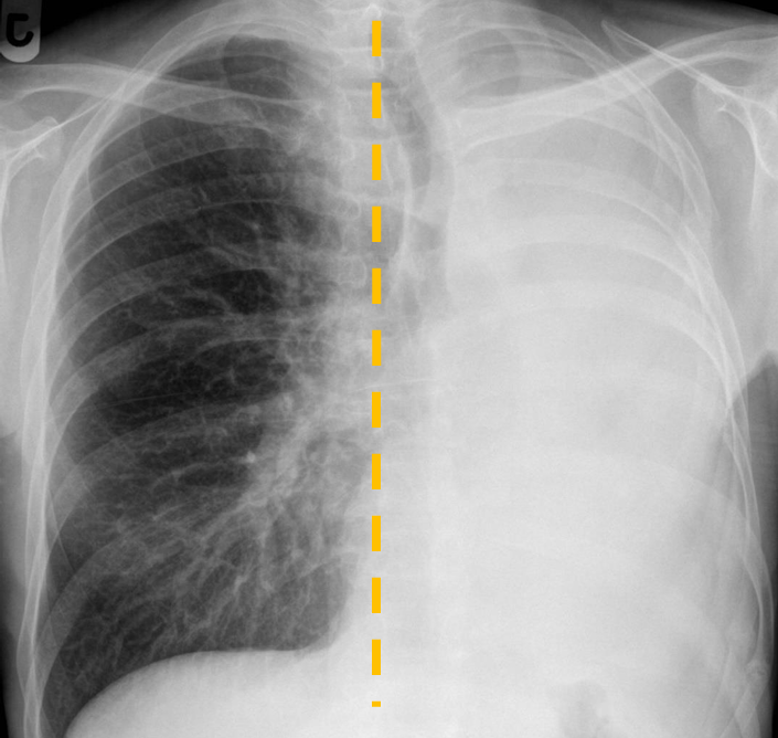 <p>Patient history: left-sided pneumonectomy, control Modality: PA chest radiograph </p><p> Region: chest, lungs </p><p>Radiologic sign: In the projection of the left lung, air-filled lung parenchyma does not present; the trachea and the heart are deviated toward the pathological side (yellow dashed line) </p><p> Diagnosis: “white lung”, state of postpneumonectomy on the left side</p>