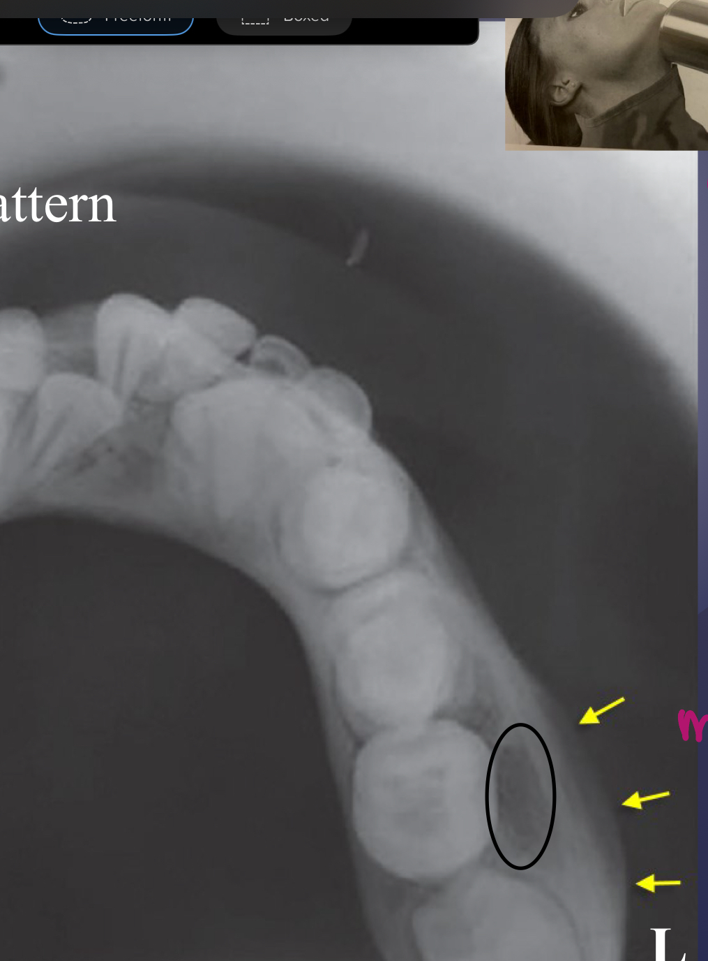 <p>which osteomyelitis phase?</p><p> some effects on surrounding structures:</p><ul><li><p>bone formation, periosteal stimulation = onion skin</p></li><li><p>bone resorption</p></li></ul><p></p>