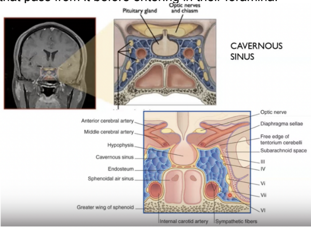 <ul><li><p>Found on the side of the body of the sphenoid bone —</p></li><li><p>Made by a plexus of veins delimited by dura mater</p></li><li><p>Contains many relavent strucutrs passing from it before entering in their foramina</p></li><li><p>Occlusion, inflammation, or thrombosis of the cavernous sinus —</p><ul><li><p>Very commonly the nerves running in it are affected aswell — causing paralysis of the eye muscles (cavernous sinus syndrome)</p><ul><li><p>CN 3, 4, V1, V2, &amp; 6</p></li></ul></li><li><p>Thrombosis — caused by injuries in the face (esp. danger triangle)</p></li><li><p>Inflammation of this area, even if not treated, can be transported into the cavernous sinus, where it can lead to inflammation or thrombosis and then it can spread to other sinuses</p></li></ul></li><li><p>Initially it would give rise to symptoms related to the paralysis of the muscles of the eyes due to the inflammation of the nerves that pass in the cavernous sinus `</p></li></ul>