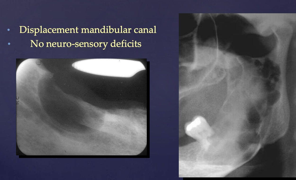 <p>displacement (no neuro-sensory deficits)</p>