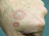 <p>What lesion shape/configuration is this? What condition can cause this?</p>