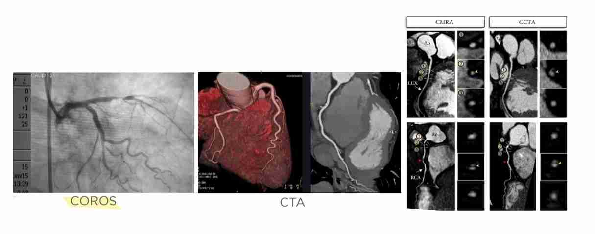 <p>Radiographic visualization of the coronary <span style="color: var(--color-neutral-black)">vessels after the injection of radiopaque contrast media.</span></p><p>Coronary Angiography can be <span style="color: var(--color-neutral-black)">done via:</span></p><p>i. X-ray Coronary Angiography or “Angiogram”/ “COROS”</p><p>ii. Computed Tomography Coronary Angiography (CCTA)/<span style="color: var(--color-neutral-black)">“CT Angiogram”</span></p><p>iii. Coronary Magnetic Resonance Angiography (CMRA)</p>