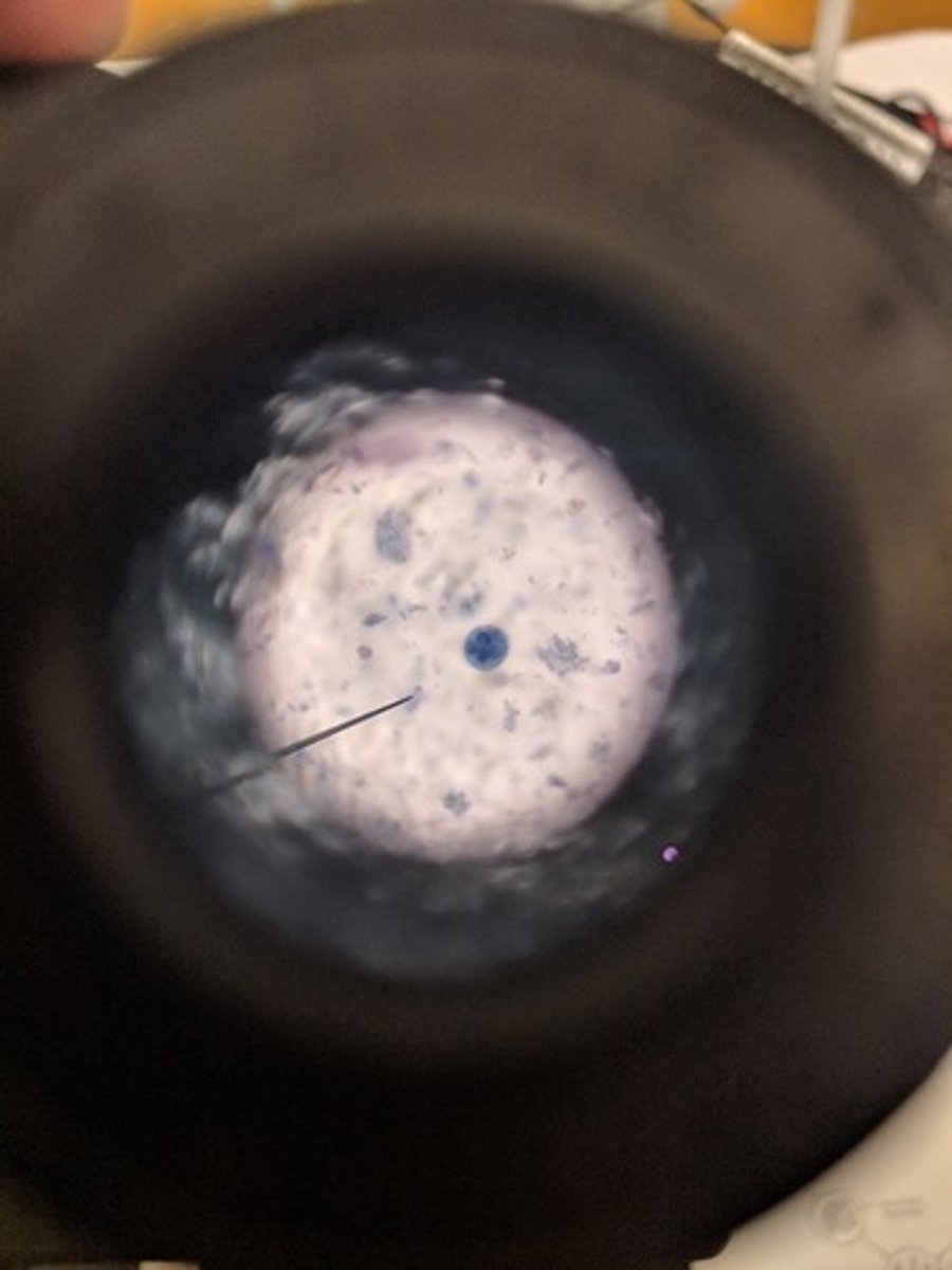 <p>Infection by ingestion of cysts in contaminated drinking water</p><p>- causes diarrhea, dysentery and liver abscess</p><p>- has chromatid bar</p><p>Dx: fexal exam/serological test</p>