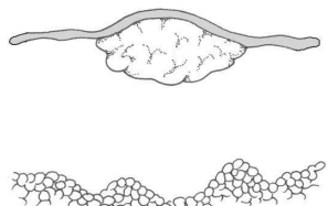 <p>Elevación pequeña de la piel, bien delimitada y sólida</p><p>Por mordedura de insecto, papiloma o foliculitis superficial</p>