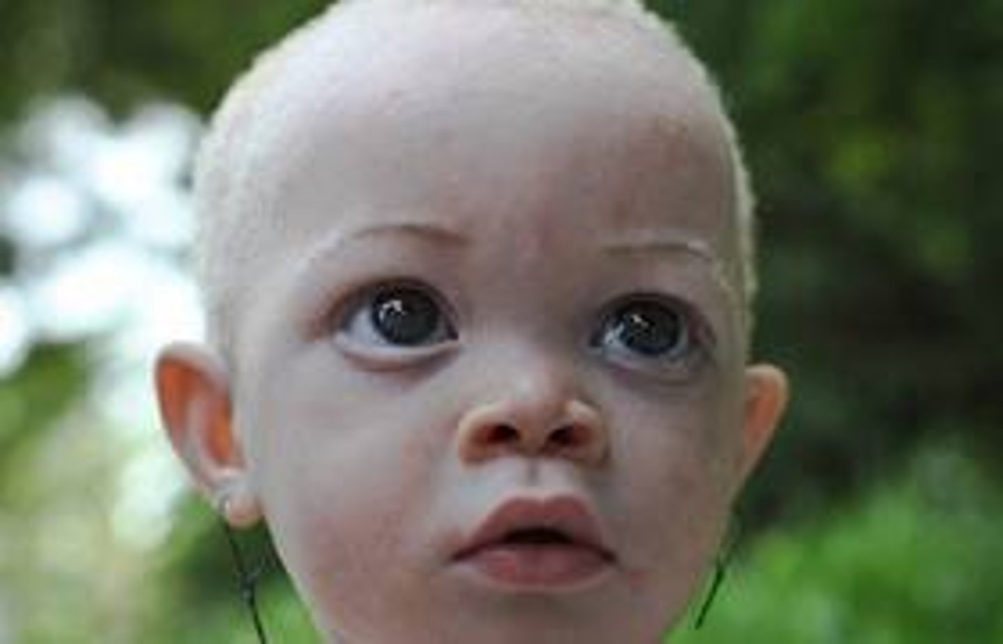 <p>rare genetic condition; lack of pigment in the body</p>