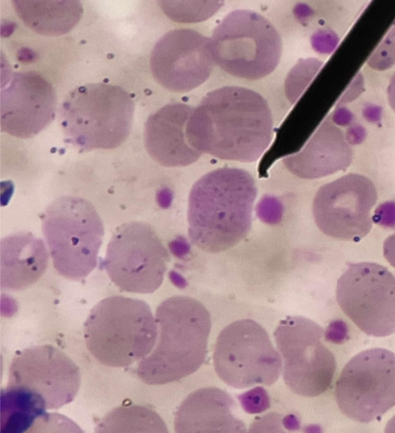 <p>A. Identify the pointed cell</p><p>B. Describe the striking feature</p><p>C. Associated with what condition ?</p><p>D. What does the inclusion found on this cell represents ?</p><p>E. Is often confused with what other inclusion?</p><p>F. What stain is used to differentiate the inclusions?</p>