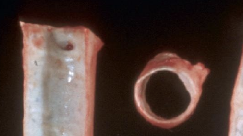 <p>What degenerative condition is due to mineralization of elastic and muscular arteries? It can be due to vitamin D poisoning, hyperparathyroidism, Mg poisoning, cachexia, has solid/dense pipelike formations, basophilic granular mineral deposits and siderocalcinosis in aged horses?</p>