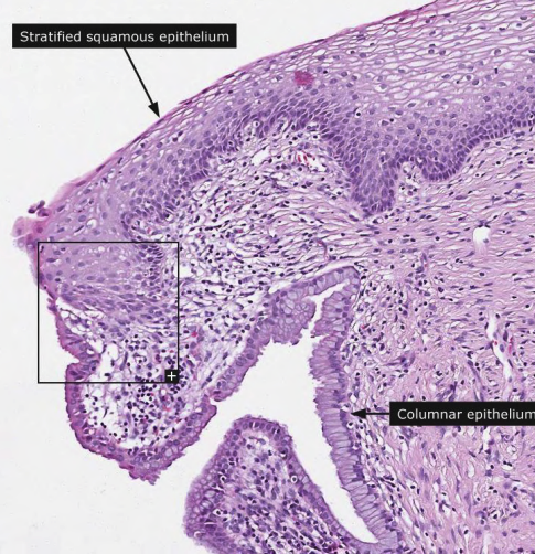 ### Metaplasia