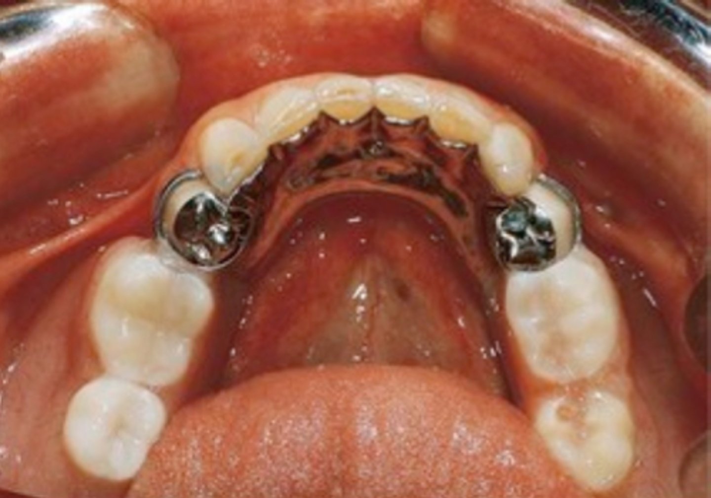 <p>Indirect retainer that is a major connector, where rest seats should be present under plate, otherwise teeth will splay</p>