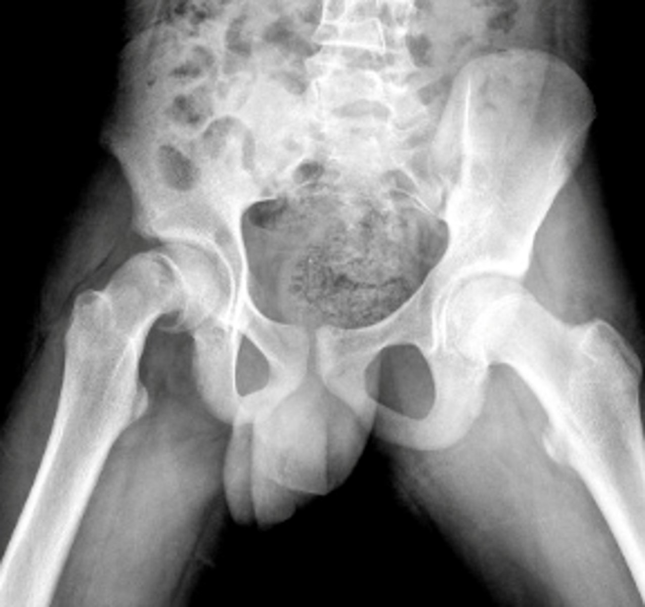 <p>gradual or acute failure of the epiphyseal plate of the head of the femur due to shear forces parallel to the growth plate, causing the head to slide posterior/inferior</p><p>*may be related to trauma, inflammation, obesity, or hormonal factors</p><p>**more likely in males, onset approx 13 yrs of age (10-17)</p><p>FUNCTIONAL DEFICITS--&gt; pain, gait changes (antalgic pattern)</p><p>COMPENSATORY MOVEMENTS--&gt; may result in growth deficits, complications include avascular necrosis</p>