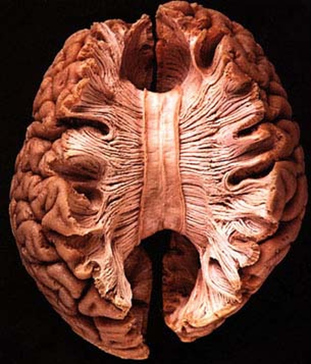 <p>largest cerebral commissure (tract that directly connects cerebral hemispheres)</p>