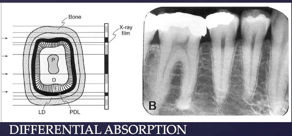 <p>Z of bone is higher than Z of soft tissue → <strong>differential photoelectric absorption</strong> within different types of tissues makes production of a radiographic image possible</p><p>anything on the x-ray that’s black: received photons vs. white: no photons </p>