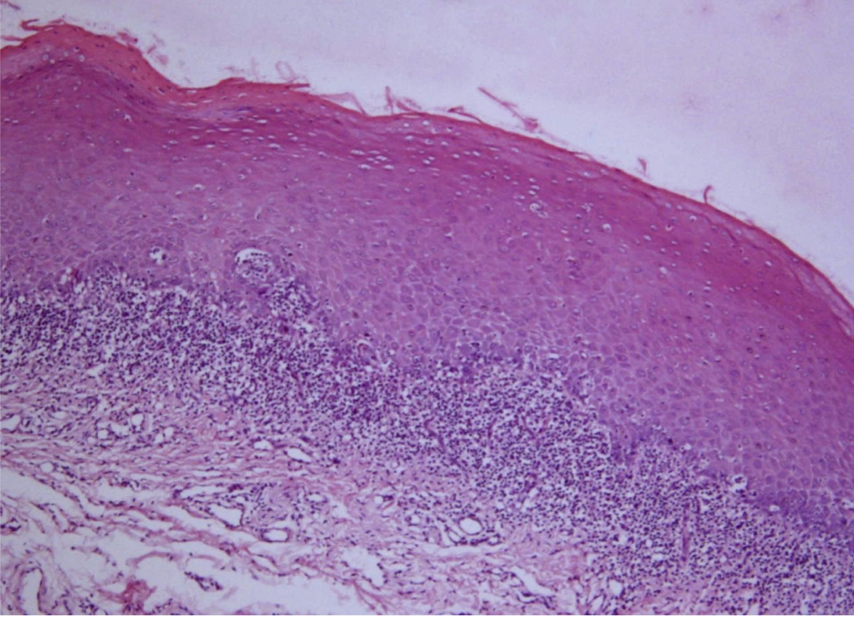 <p>A 52year old patient presented with white lesions on tongue on both sides. There is severe burning sensation. A biopsy was taken and the histopathological image is shown here. What is your diagnosis?</p>