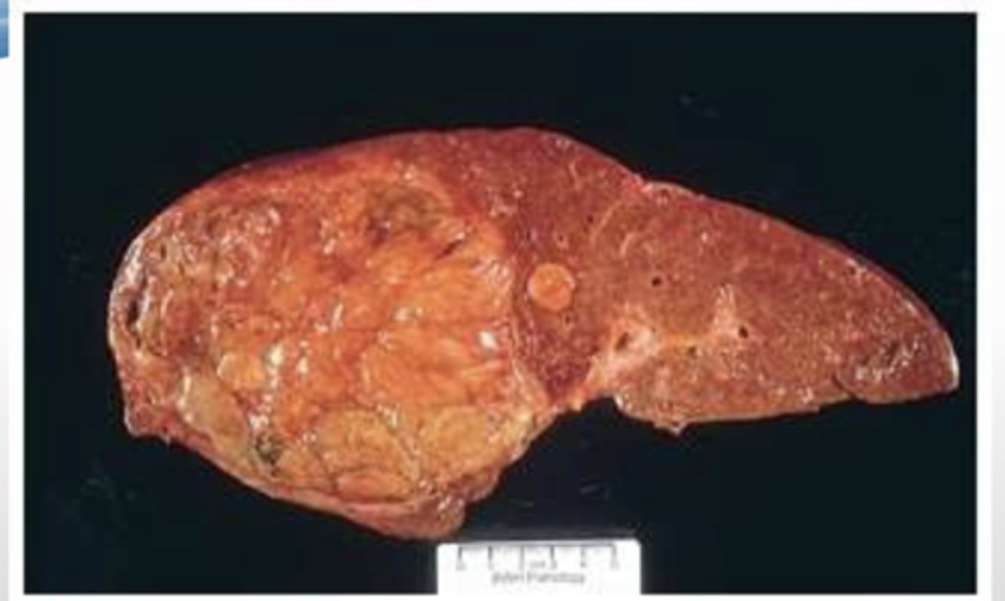 <p>hepatocellular carcinoma (hepatoma)</p><p>-associated w/ infection, hepatitis, cirrhosis, hemochromatosis, &amp; AAT deficiency </p><p>-symptoms--&gt; ab pain, swelling, weight loss, weakness, jaundice, fever, loss of apeptite</p><p>-propensity for vascular invasion (inclination to invade vascular system)</p><p>-death due to hemorrhage and liver failure</p><p>-may be cured by liver transplant </p>