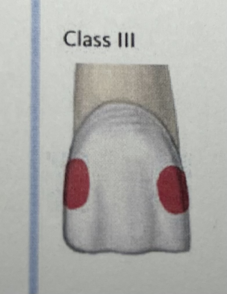 <p>Decay is on proximal mesial or distal surfaces of anterior teeth</p>