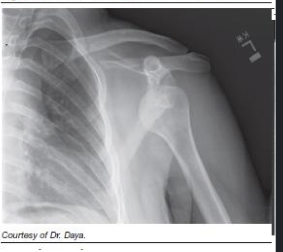 <p>What is the clinical diagnosis of this dislocation?</p>