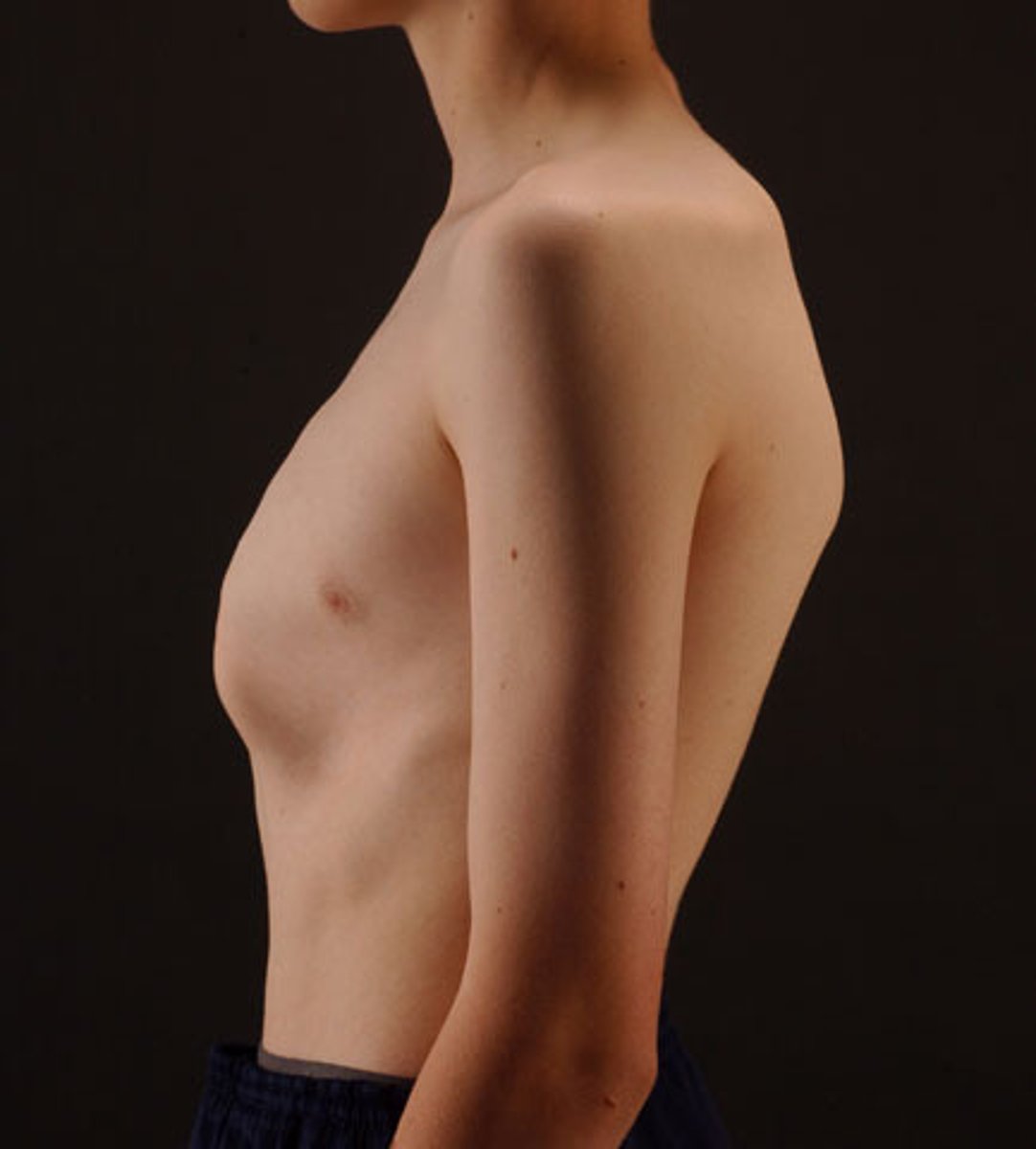 <p>-protrusion of upper or lower portion of the sternum </p><p>-males</p>