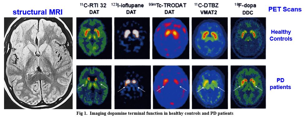 <p>non-invasive imaging indicates that dopamine loss initially appears in the putamen of PD patients</p>