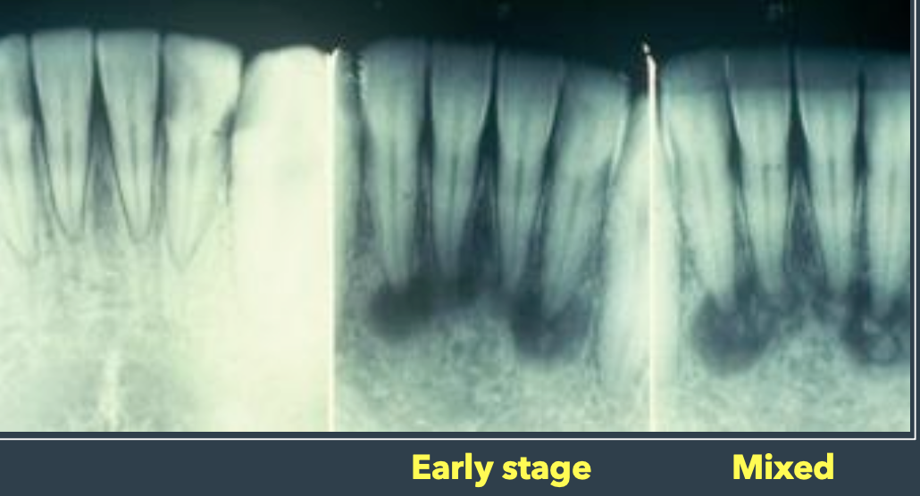 <ul><li><p>Located near periapical region of the anterior mandible</p></li><li><p>Multiple foci are usually present</p></li><li><p>Teeth are invariably <strong>vital and asymptomatic</strong></p></li><li><p>Early lesions are circumscribed areas of RL involving the apex of a tooth </p></li><li><p>looks identical to that of a periapical granuloma or cyst</p></li><li><p>The PDL will be intact; the lesion will NOT fuse to the tooth</p></li><li><p>Lesion is typically non-expansile self-limiting</p></li></ul><p></p>