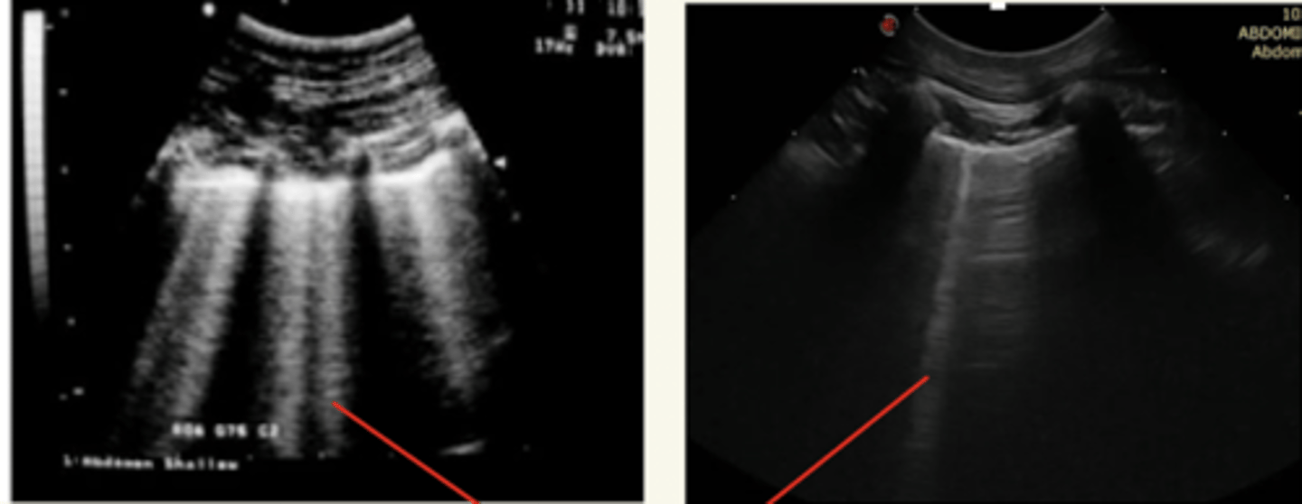 <p>colas de cometa (líneas hiperecoicos verticales) en el pulmón.</p><p>NO son normales- indican derrame pulmonar</p>