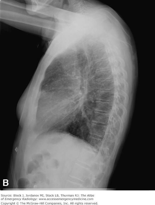 <p>CHF Interstitial Findings</p>