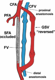 <p>CFA to distal PTA</p><p>bypass fem-pop occlusion</p><p>*remove GSV &amp; flip upside down; cut perforators</p><p>*connect prox v to CFA &amp; distal v to PTA</p><ul><li><p>vein small end to artery large end</p></li></ul><p>***V decreases distally bc diameter increases</p>