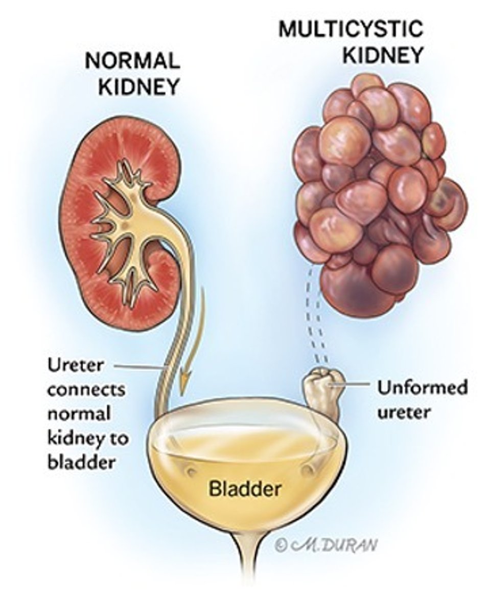 <p>multicystic dysplastic kidney disease (MCDK)</p>