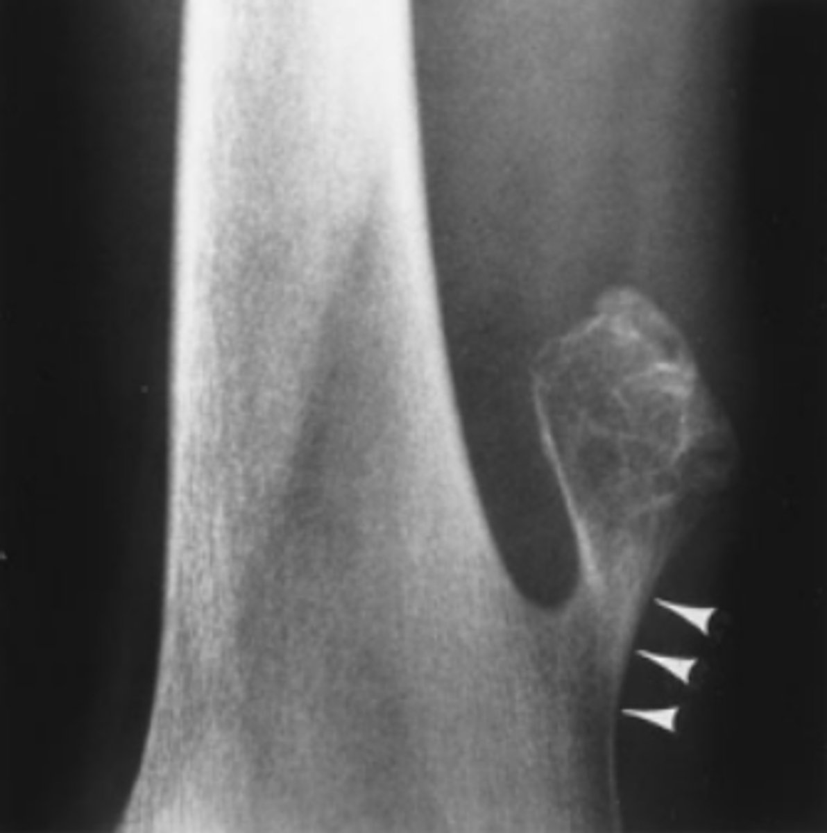<p>What is the lump in Case 6-9 (Figure 6-22)?</p><p>A. An osteosarcoma</p><p>B. An osteochondroma</p><p>C. A normal variant</p><p>D. A soft tissue sarcoma</p>